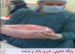 عمل جراحی تومور 8 کیلویی در بیمارستان تامین اجتماعی شریعتی اصفهان